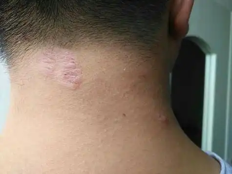 花皮癣早期症状图片 牛皮皮癣图片早期症状