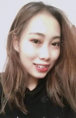 下排右边这颗倒着的虎牙应该是马上就要站起来了.