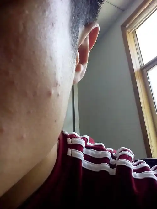 脸上起这种疙瘩是什么因素造成的?