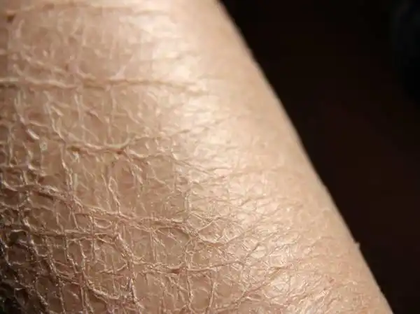 皮肤缺水干燥起皮怎么办