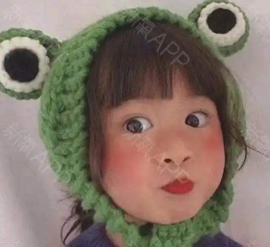 自体脂肪填充全脸