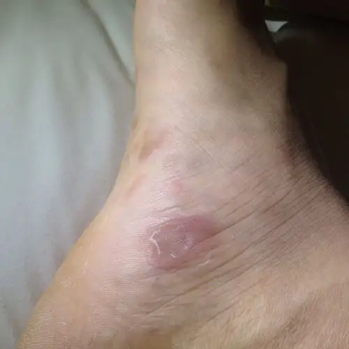 脚底出现暗红色斑点是什么?怎么办?如图