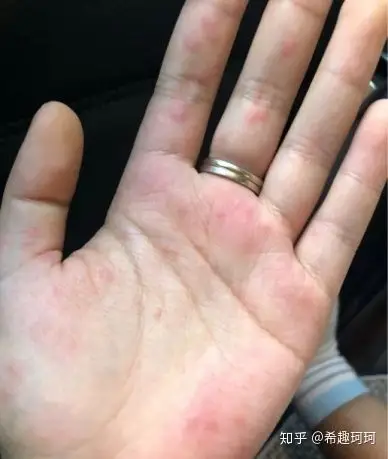 得了季节性湿疹怎么办?