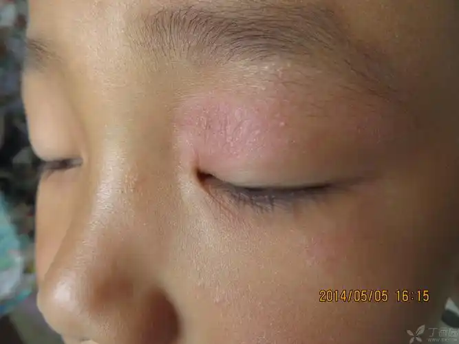 【请教】单侧上眼睑皮疹诊断湿疹正确吗 - 皮肤与性传播疾病讨论版