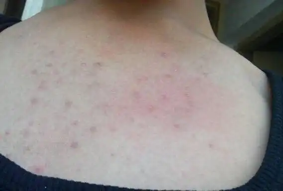 前胸后背痘痘多, 是这种真菌引起的毛囊炎, 1招搞定