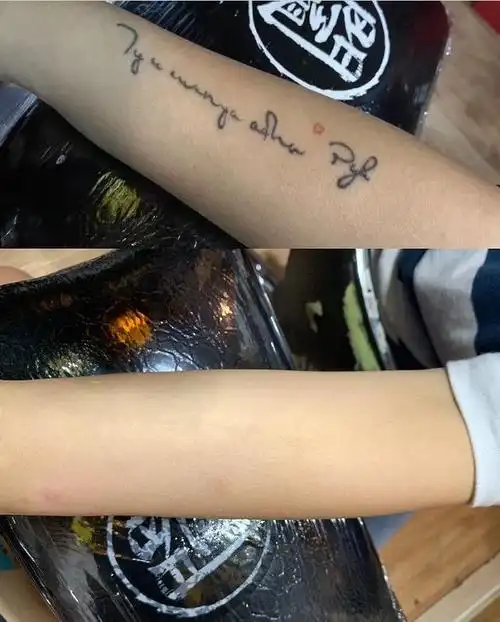 山东洗纹身多少钱?