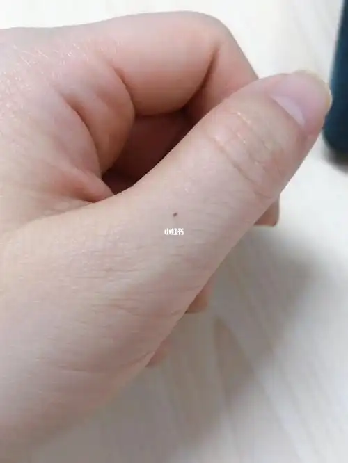 突然发现大拇指上有个黑点,以为蹭到了什么,抠了一下,发现是一个痣