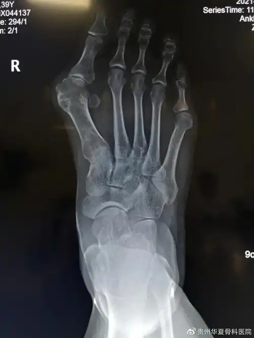 走路疼痛不敢穿凉鞋贵州华夏骨科医院有治疗大脚骨的好方法