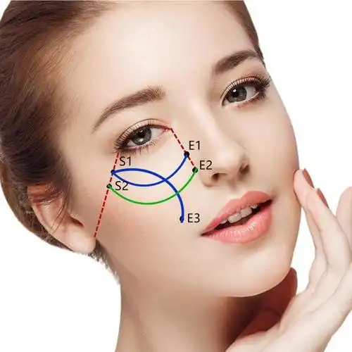 比如面部线雕是大家比较熟悉的,可以让皮肤变得更紧致,但是线雕的副