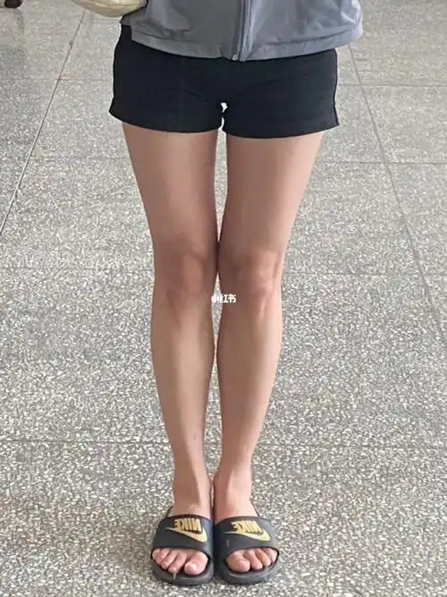 大腿中间的缝是正常的吗