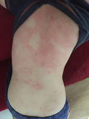 孩子过敏全身起红点痒怎么办?