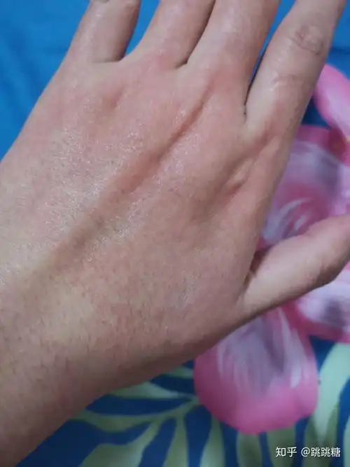 泰尔丝异维a酸乳软胶囊手背上刺痛