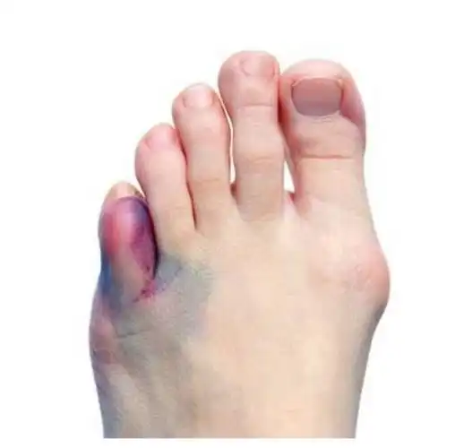 患者教育:足趾骨折(基础篇)_骨折_介绍_症状表现_检查_治疗方式_日常