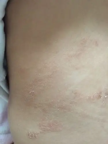 医疗问题,我家小孩背部长很多皮肤鲜!