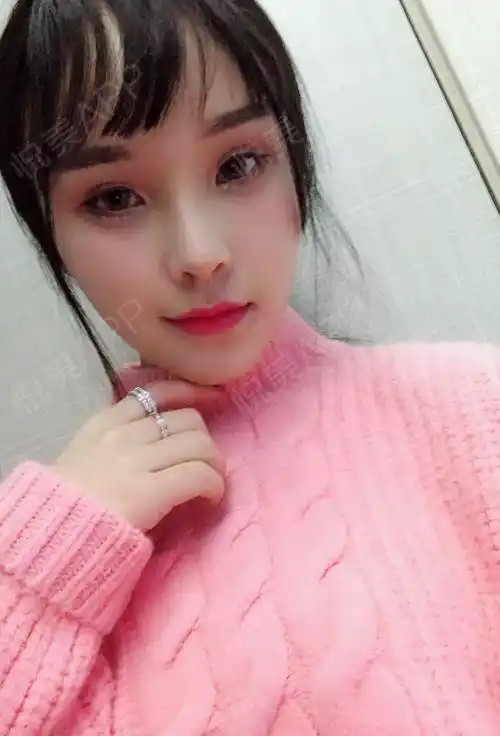 自体脂肪面部填充术后15天_面部填充术后15天_自体脂肪术后15天_面部