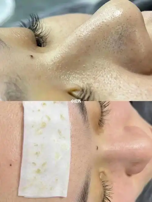 95毛囊清洁术一次效果对比90