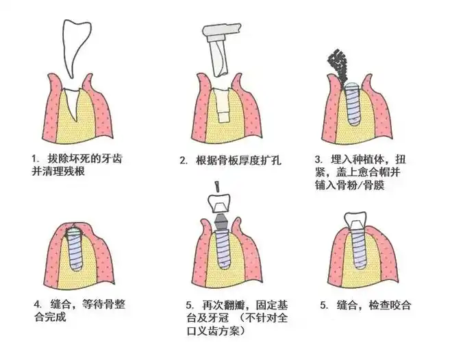 种植牙的过程一般需要分为三期来进行操作,以下是操作步骤:1.