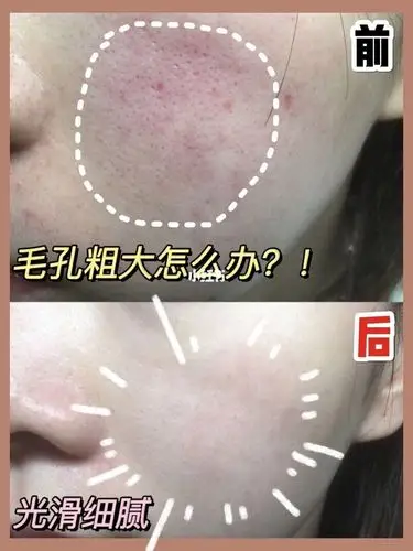 男生毛孔粗大怎么办收缩毛孔精华液分享