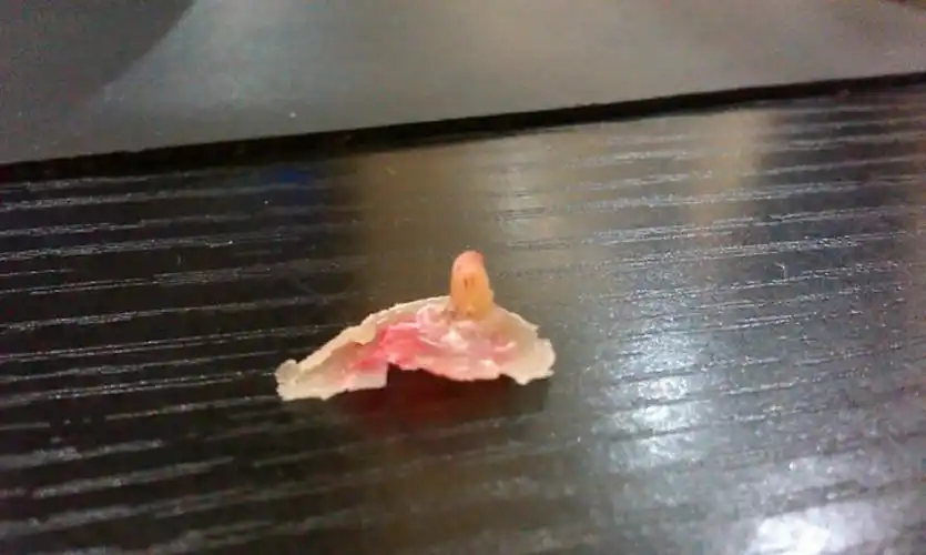 被拔出来的鸡眼图片