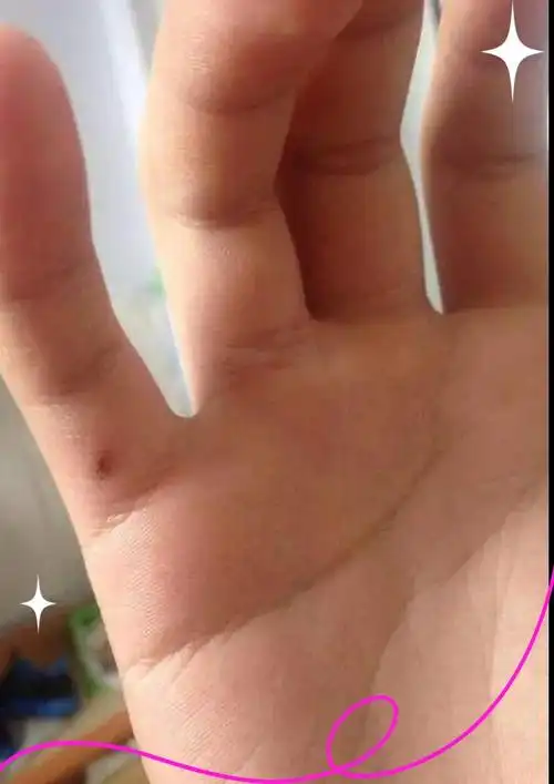 小指有痣的命运与性格解读
