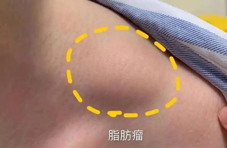 一般没有危害性,无疼痛(少数脂肪瘤在生长较为快速的时候会带有胀痛)