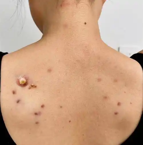 支你一招,彻底解决螨虫痘!_方法_后背_洗头