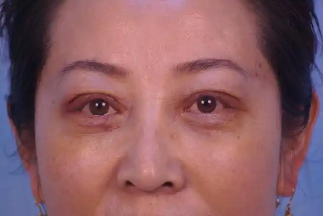 医生科普|60岁终于把双眼皮和眼袋做了,谈谈我的几点真实感受