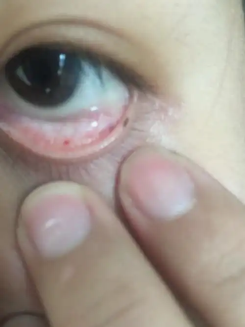 早上起床发现眼睛里面长了个小红点,不疼不痒,有没有问题啊?用不用