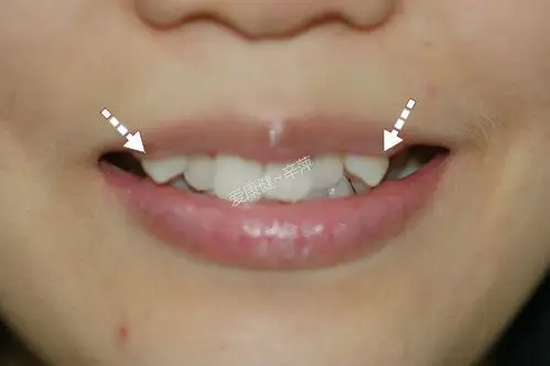 长了虎牙能矫正吗