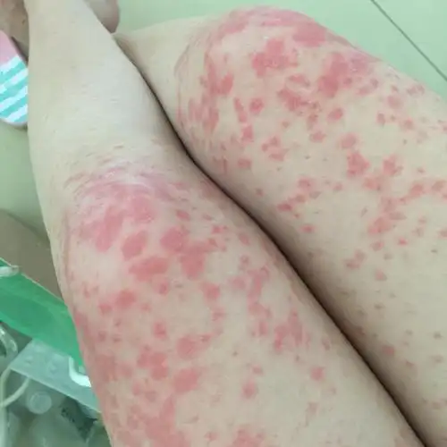 可是另一个专业看皮肤的医生说我不是荨麻疹而是因为药物过敏!