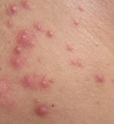 这是一种真菌性毛囊炎,由马拉色菌感染引起.