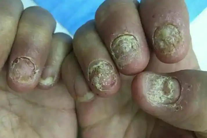 甲癣的症状图片_有来医生