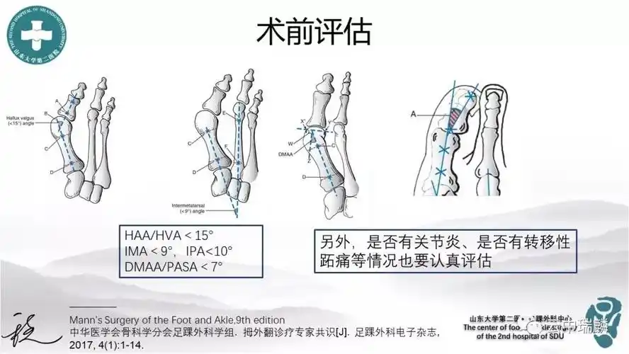拇外翻的病理解剖及手术策略,讲的太好了!