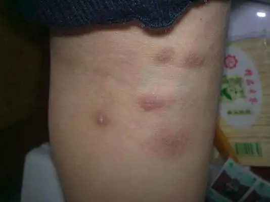 疥疮结节图片 (7)