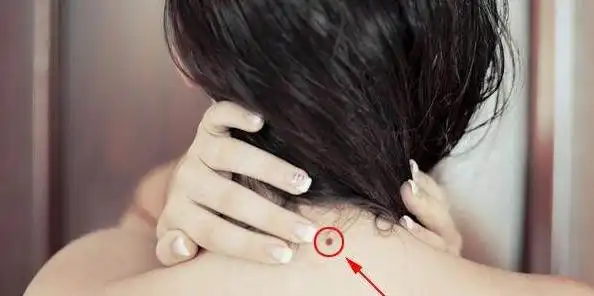 脖子有一物,财运挡不住,脖子有这些痣,男旺财,女旺夫,富贵命