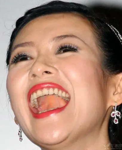 【资源共享】章子怡的好牙和杨紫琼的右上后牙下垂.