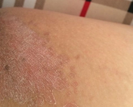 体股癣初期现象图片8