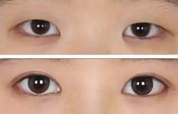 提上睑肌腱膜折叠矫正亚洲人轻中度上睑下垂