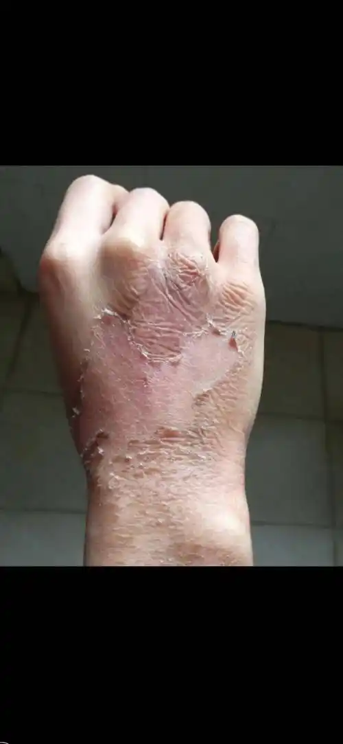 被油烫伤怎么处理手被油烫伤了家用处理方法