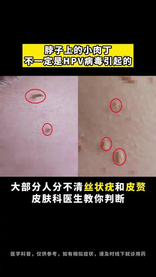 第1集|99%的人分不清自己脖子上的小肉丁是 丝状疣 还是 皮赘 科普