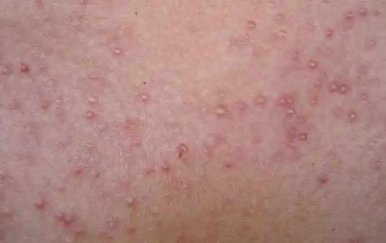 毛囊炎有这3种类型不同类型的症状不同