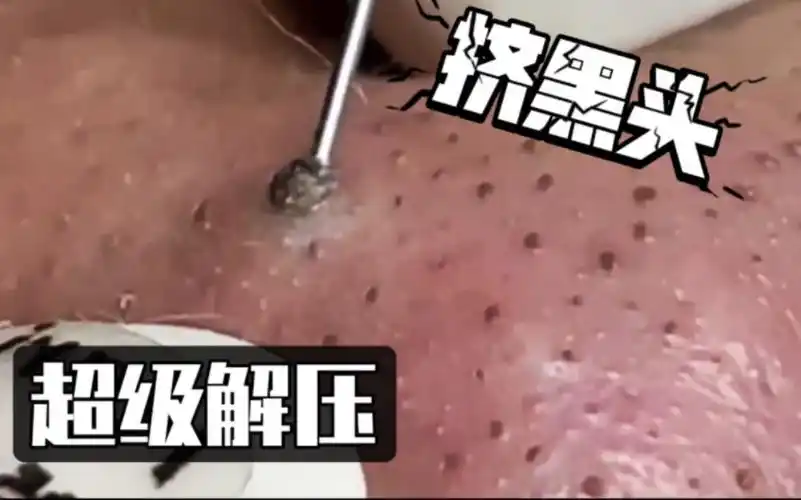 治愈系解压:简简单单,挤黑头,超解压