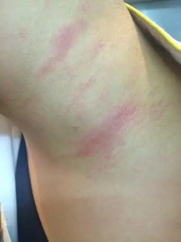 早上起来,发现脖子上长了这些红的,有一点痒,这是什么东西?