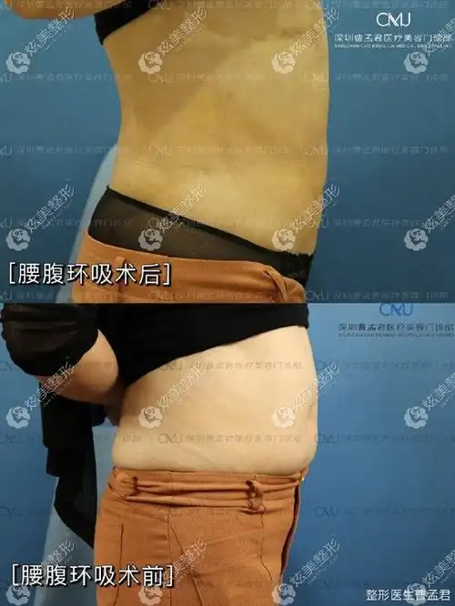 28000元找曹孟君医生做土麦森腰腹吸脂前后对比