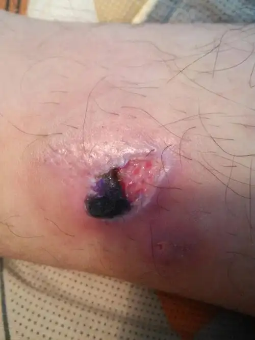 之前是烫伤 自己消毒处理后 已经结痂可是这两天一半的痂掉了就这样了