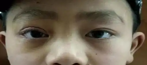 上睑下垂可以分为,先天性上睑下垂和后天性上睑下垂先天性上眼睑下垂