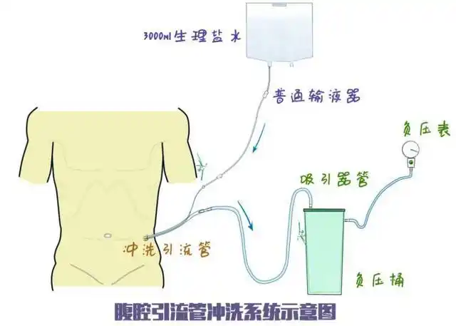 即学即会:教你轻松搞定腹腔引流管冲洗