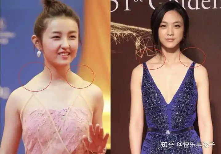 而斜方肌发达就需要打瘦肩针来改善了,不知道自己属于哪种情况的可以