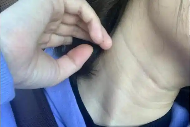 颈部淋巴结肿大的症状