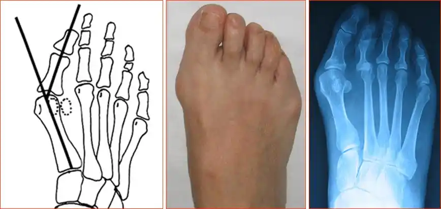 大型ipa角(interpha-langealangle)正常11-18°Ⅳ特殊类型拇外翻Ⅲ